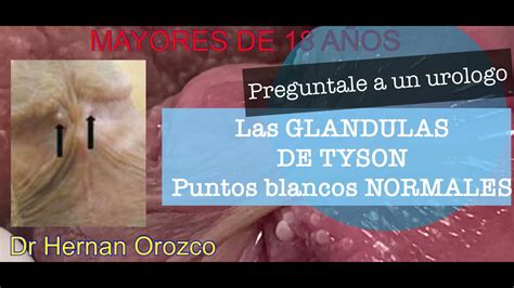 que son las glandulas de tyson|¿Por qué salen las glándulas de Tyson o bolitas。